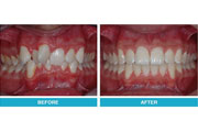 Orthodontics treatment